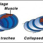 collapsed trachea